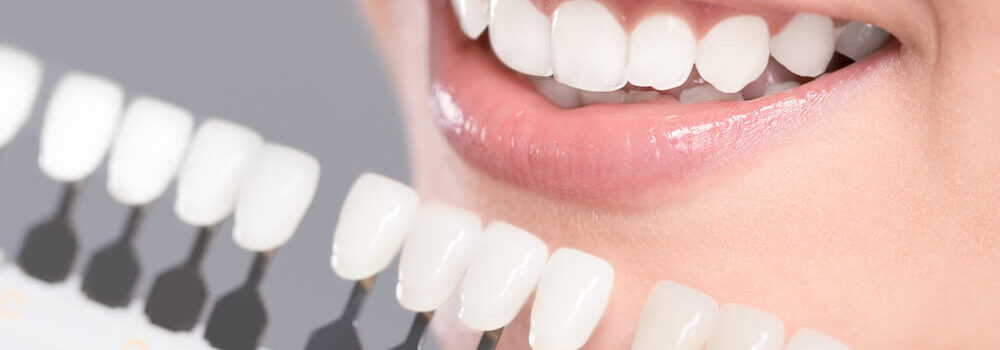 Co to są licówki stomatologiczne?