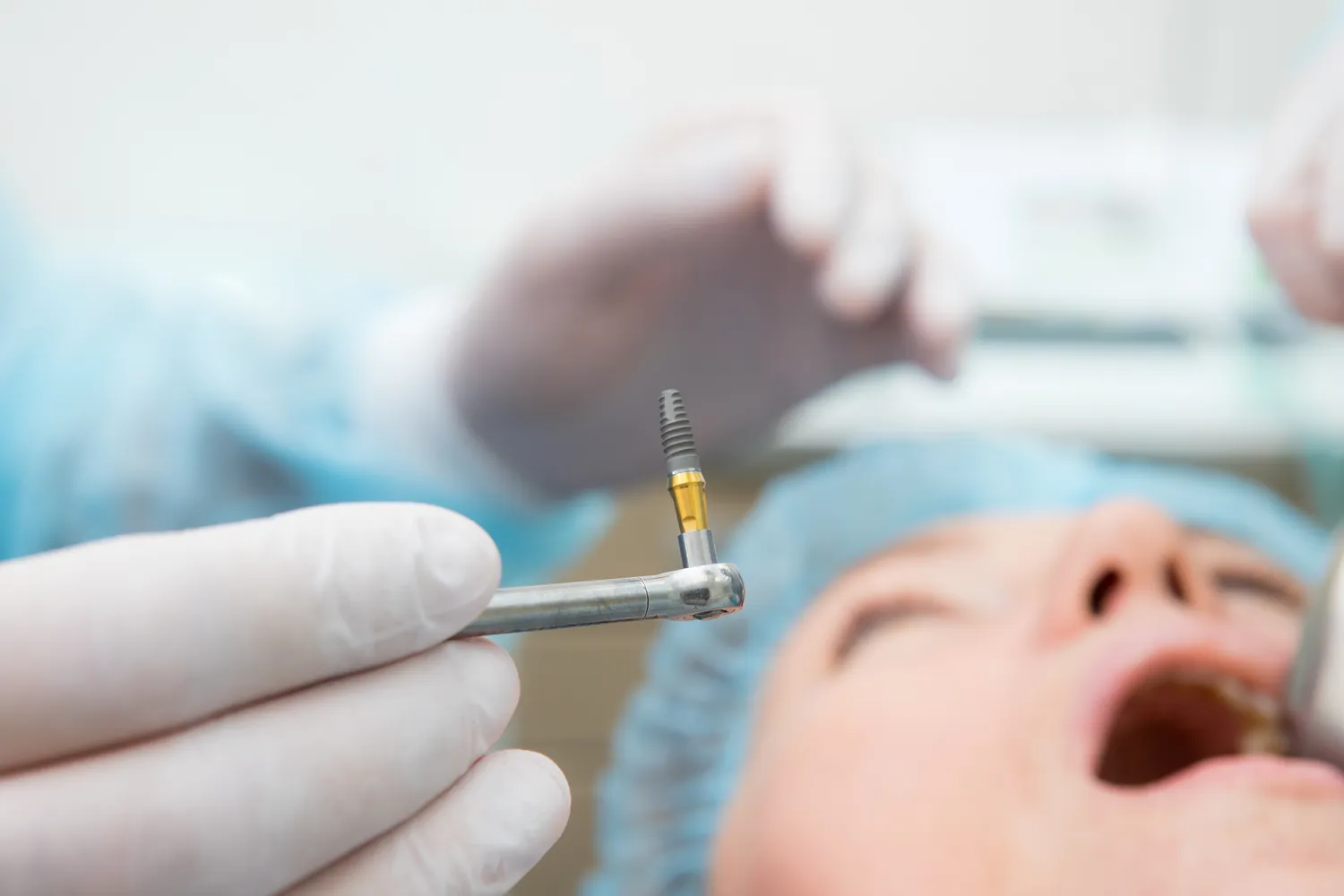 Jak wygląda zabieg wszczepiania implantów zębowych?