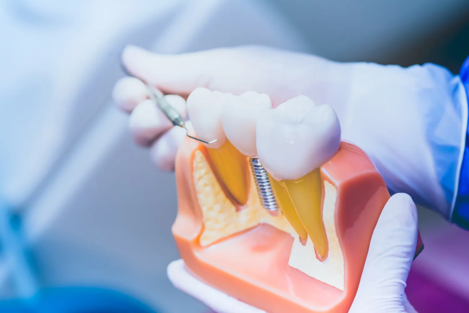 Rodzaje implantów zębowych